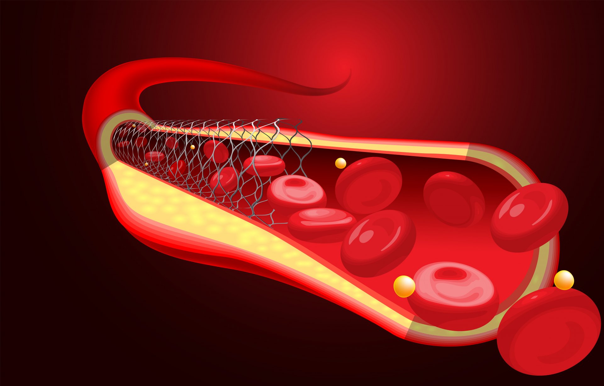 OMI (OPEN MEDICAL INSTITUTE) SEMINAR: LIPIDI I  ATEROSKLEROZA